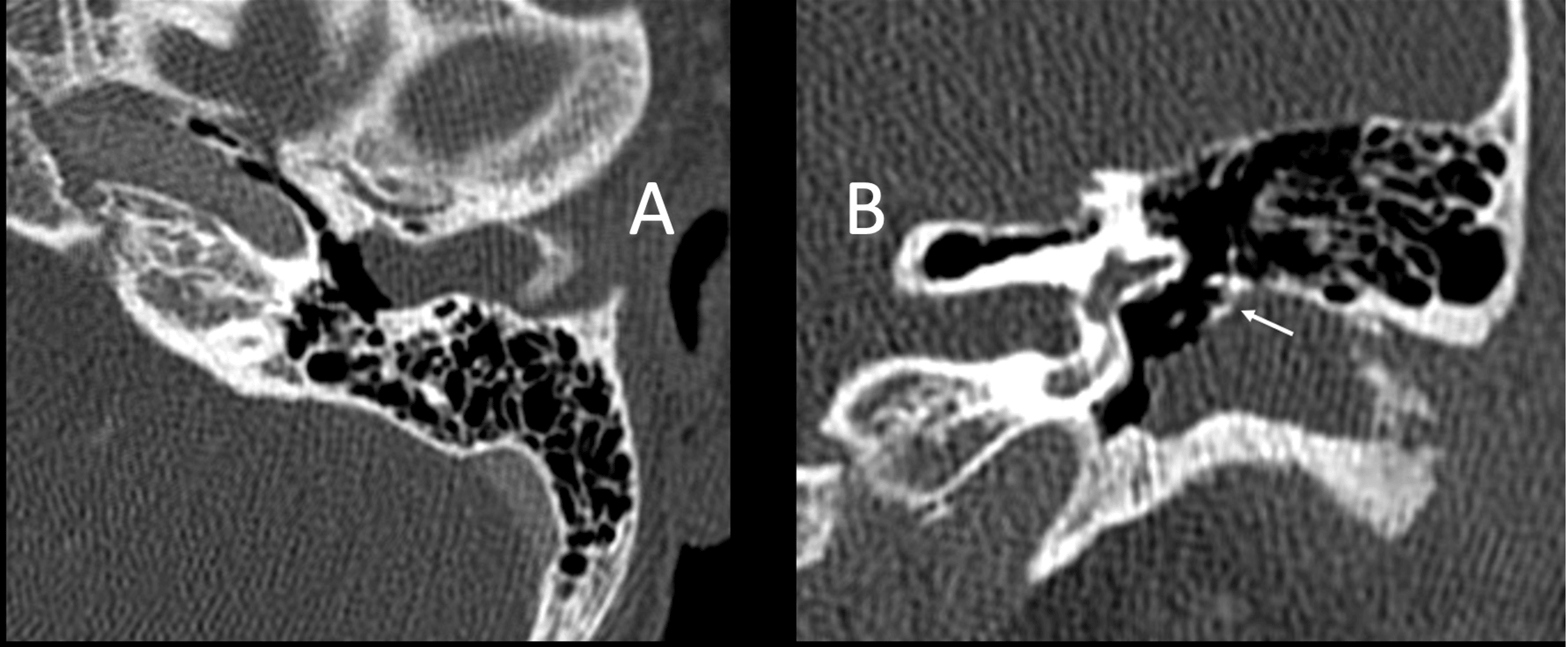 Cholesteatoma: Canalplasty for External Auditory Stenosis in a ...