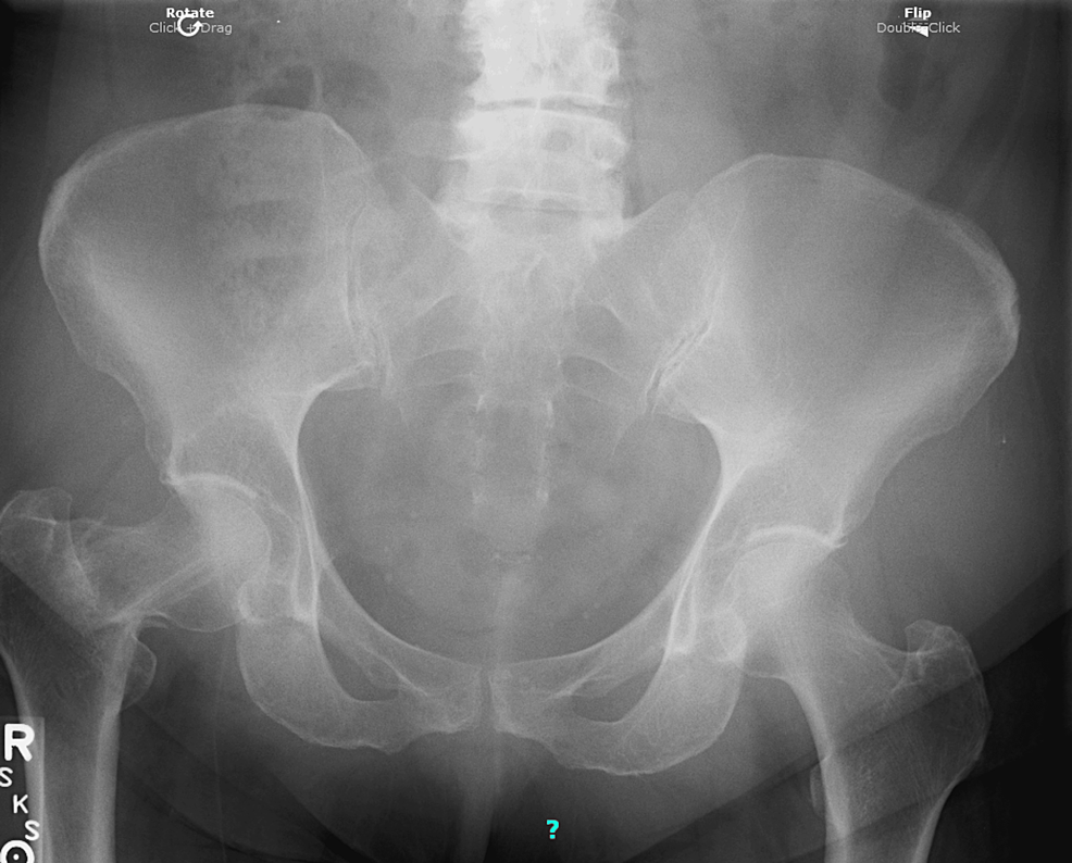 Cureus | Impacted and Angulated Right Hip Fracture in a Patient ...