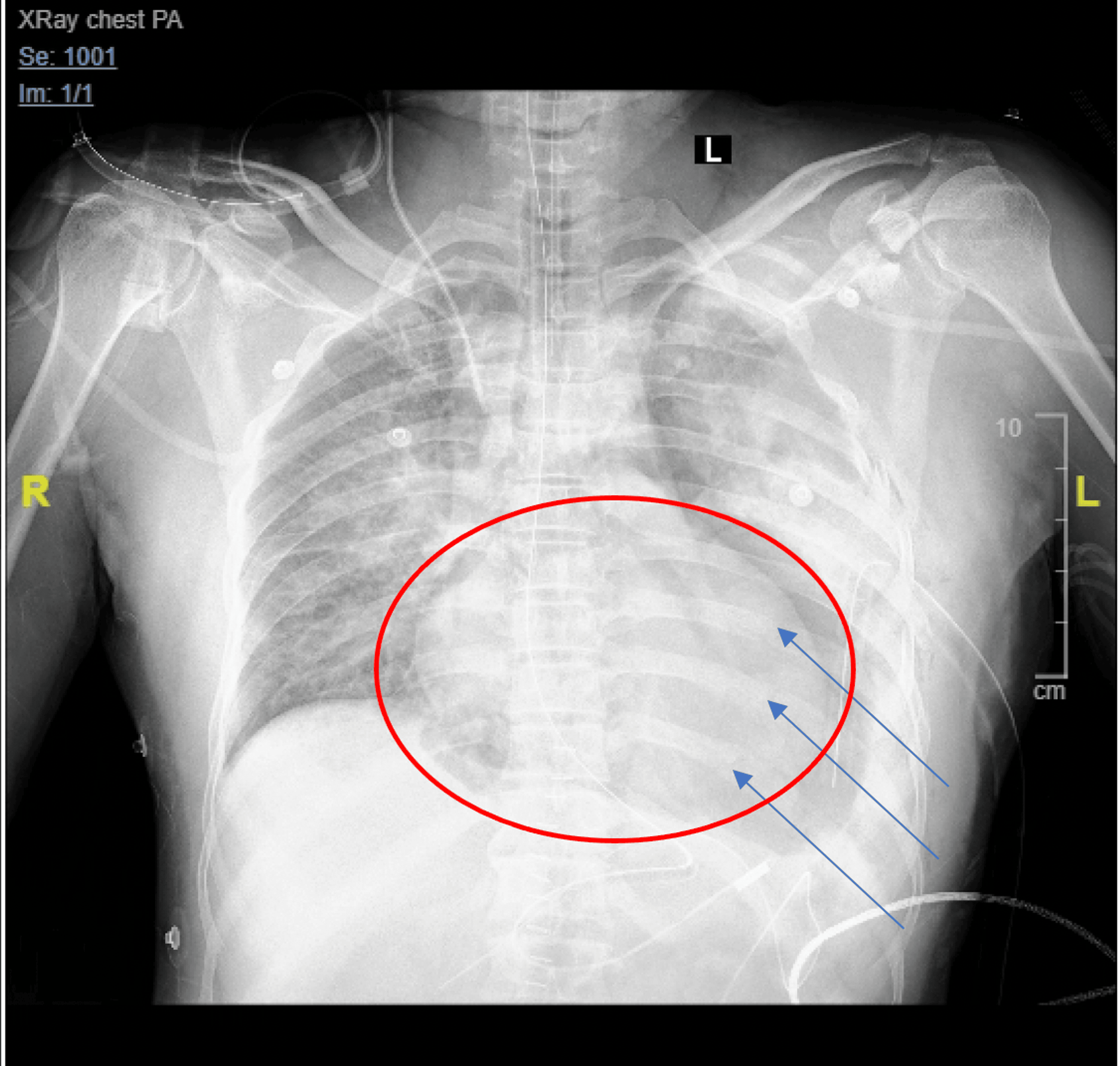 A Case of Traumatic Diaphragm Rupture: A Differential Diagnosis Not to ...