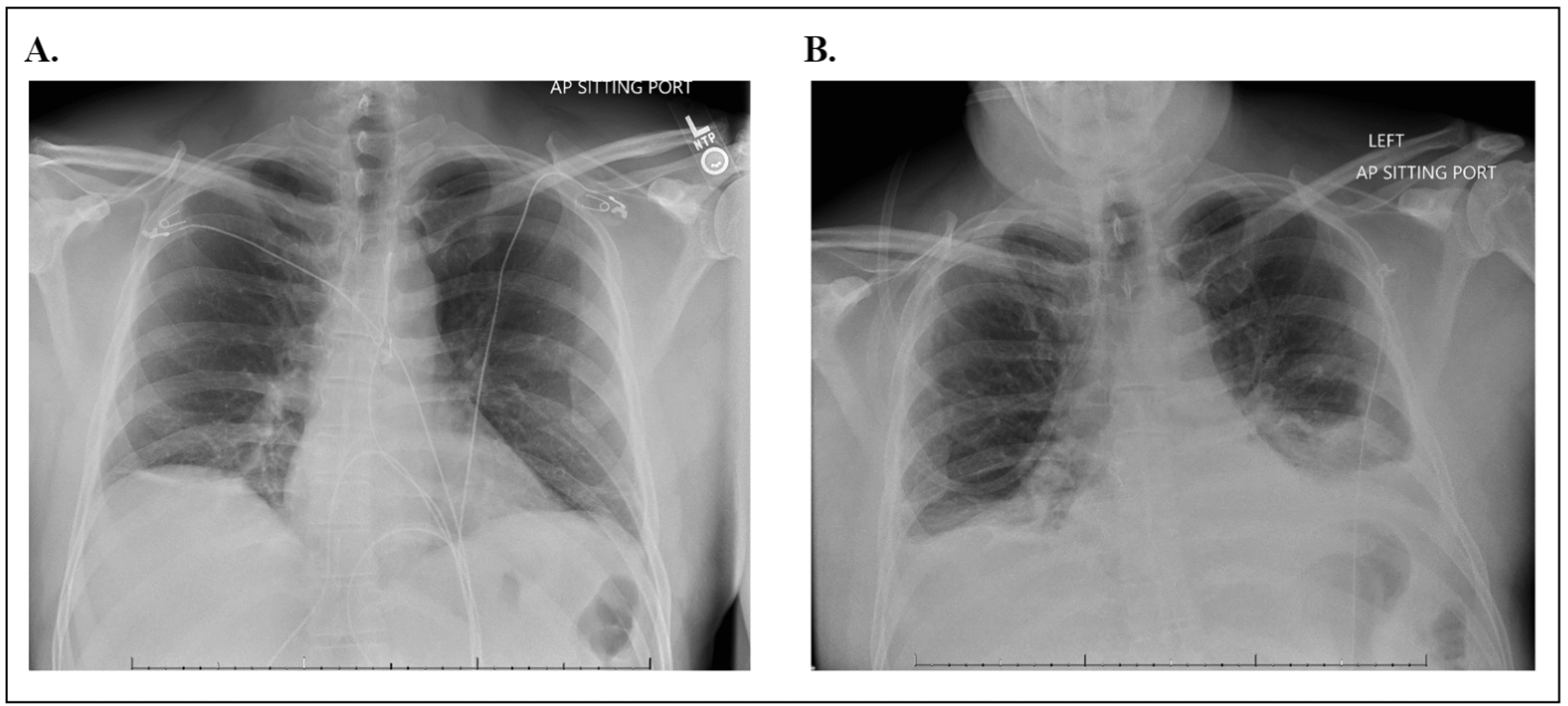Ceftriaxone Resistance in Campylobacter Gastroenteritis Cureus