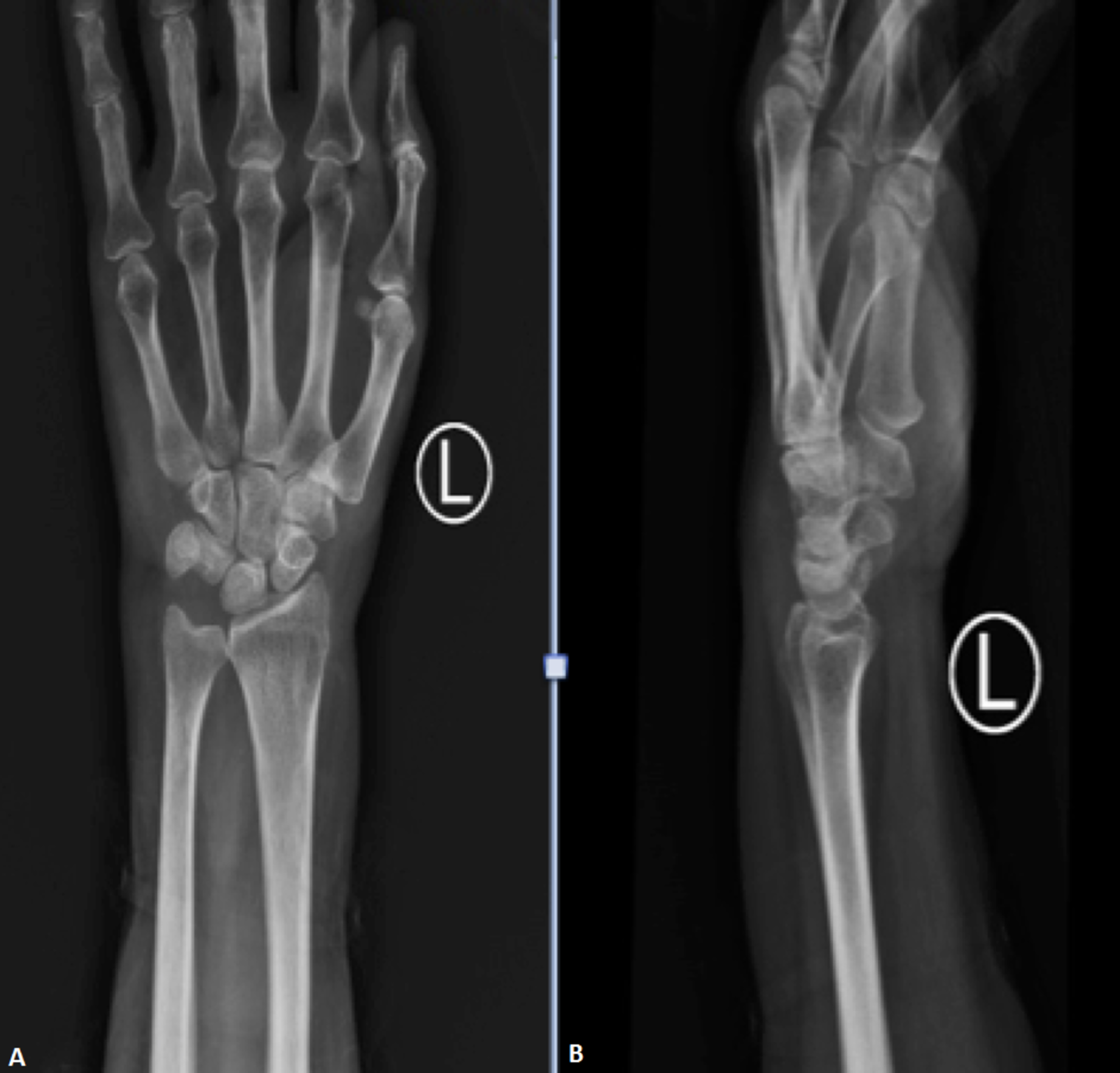Top 93+ Pictures Normal X-ray Of Hand And Wrist Sharp 10/2023