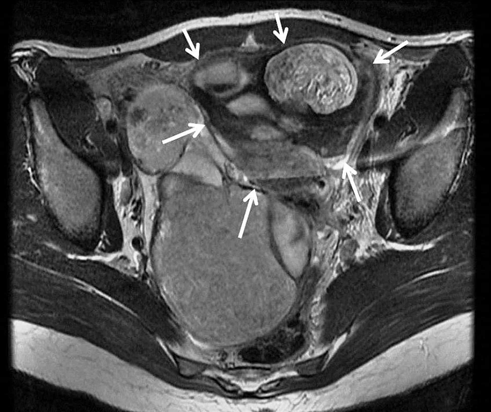 Cureus A Missed Diagnosis Of Ovarian Torsion In A Patient With Bilateral Ovarian Dermoid Cysts 