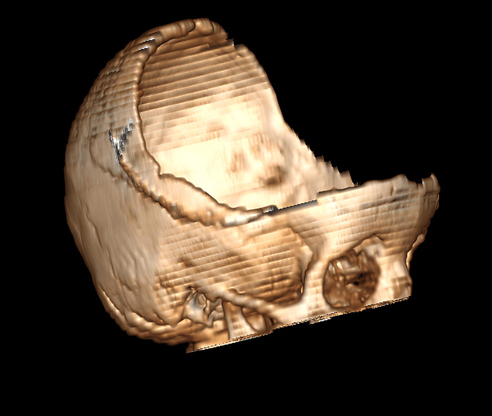 Cureus | bilateral frontoparietotemporal craniectomy for traumatic