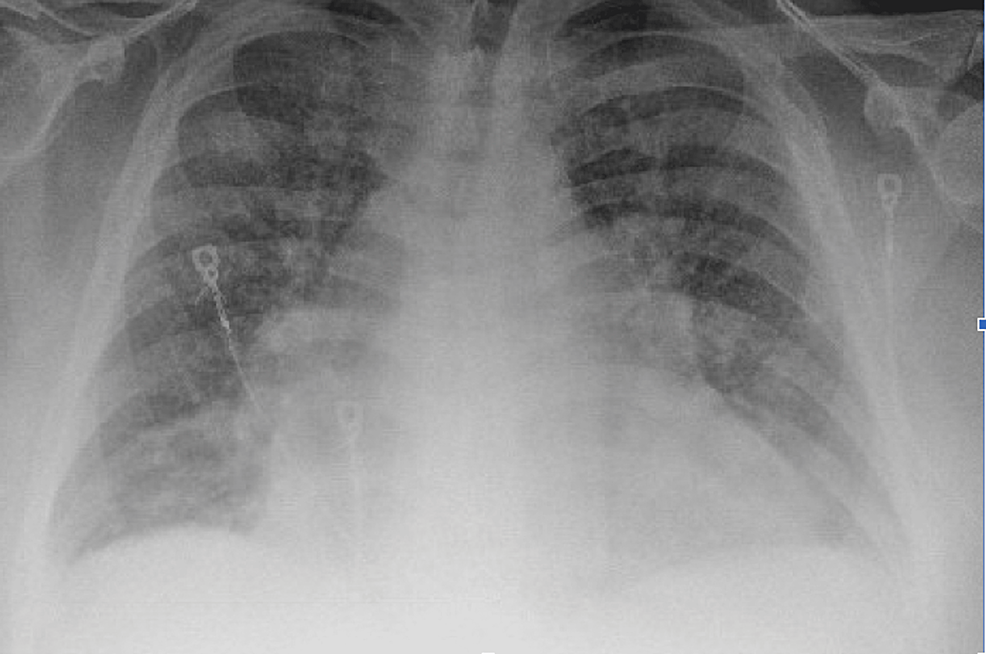 Wykraczanie poza tlen: opis przypadku dotyczy ryzyka niekontrolowanej suplementacji diety w przewlekłej obturacyjnej chorobie płuc (POChP).