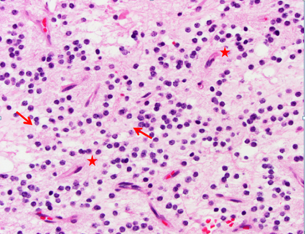 Cureus | Case Report: A Rosette-forming Glioneuronal Tumor in the ...