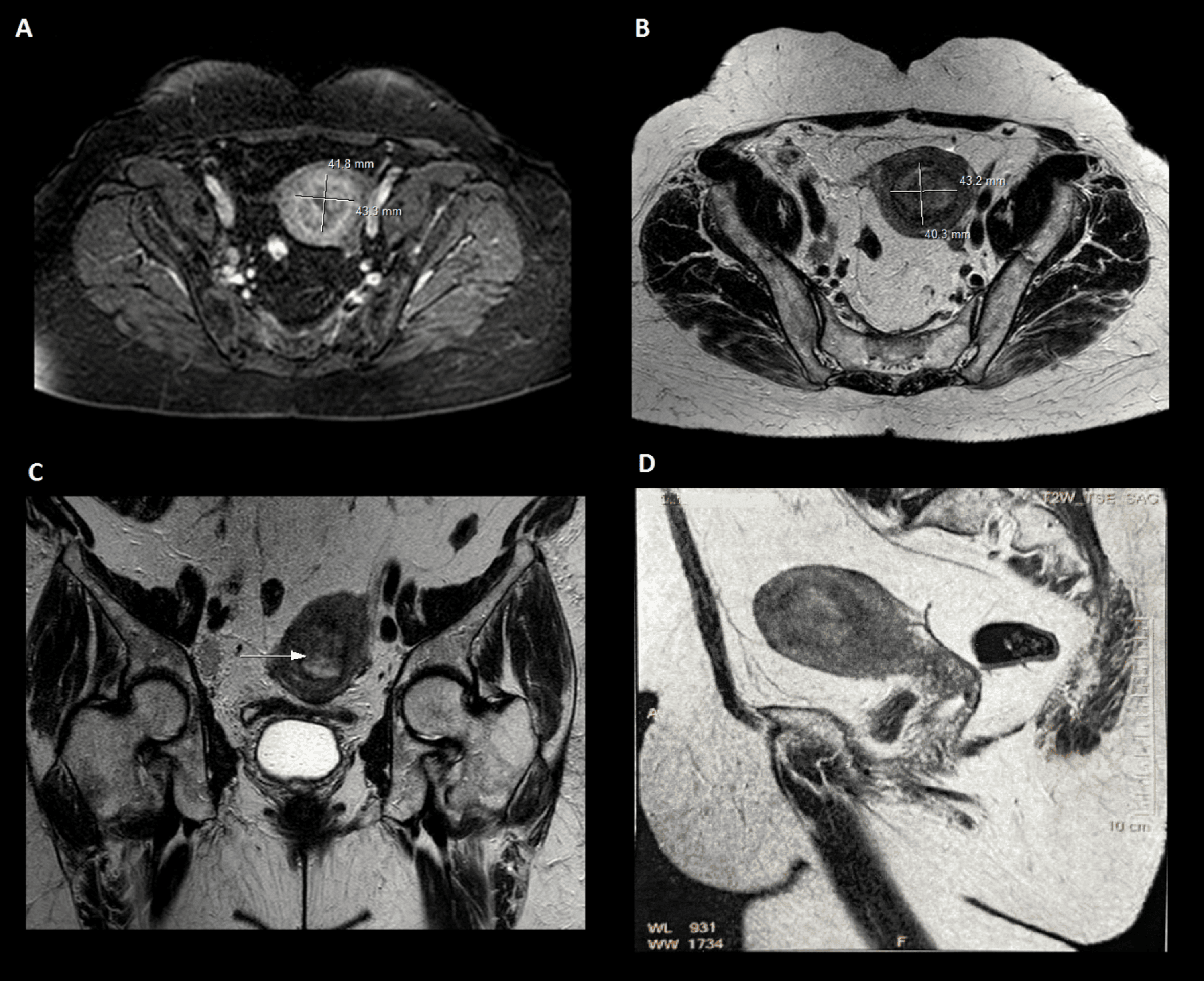 Cureus | A Case Report of Uterine Müllerian Adenosarcoma With ...