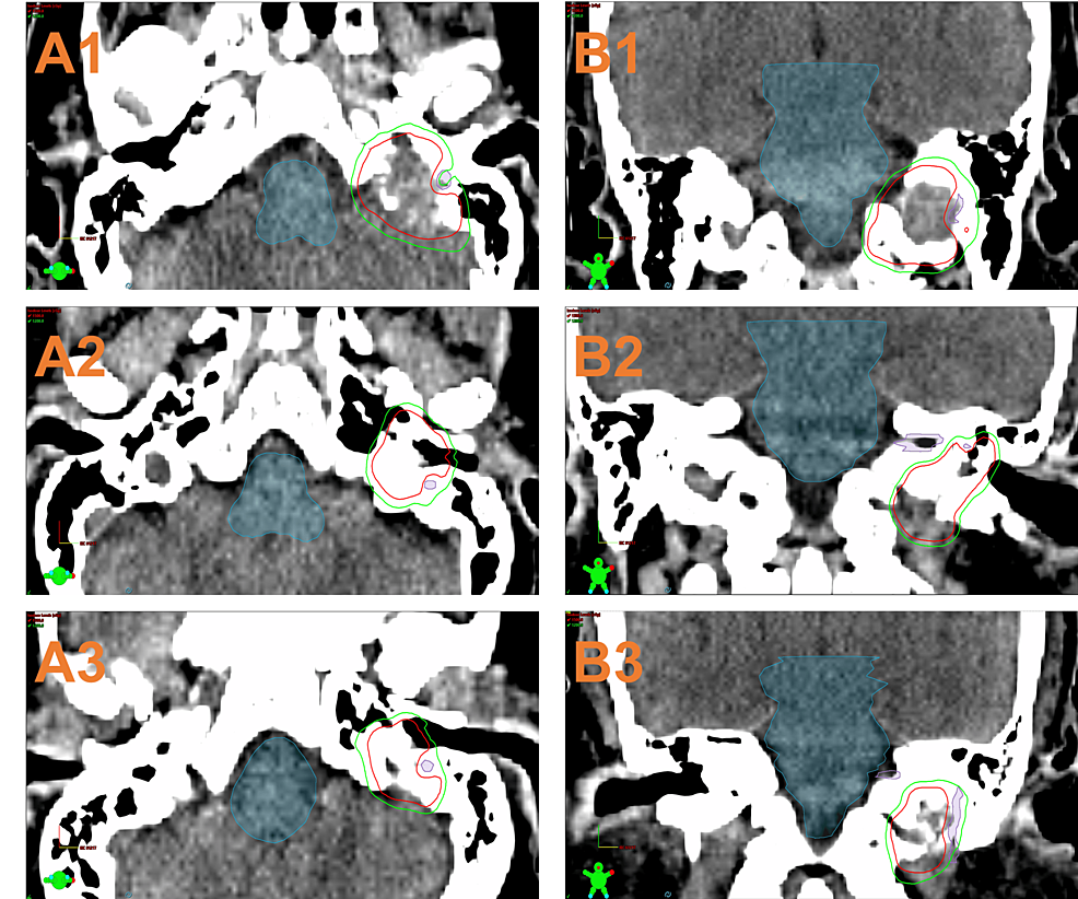 DosePainting Linear Accelerator Radiosurgery of Glomus Jugulare With
