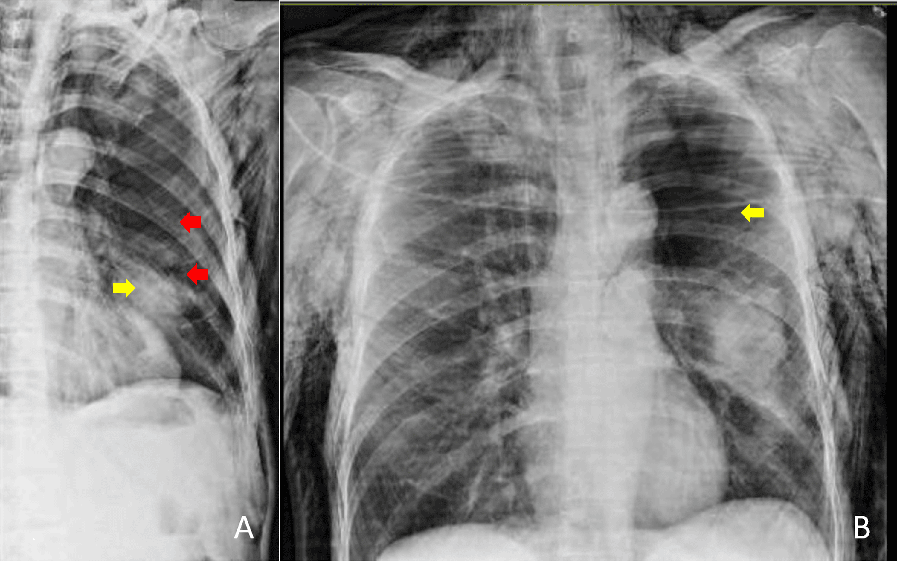 Fluttering Under Left Rib Cage - nzbs2yh