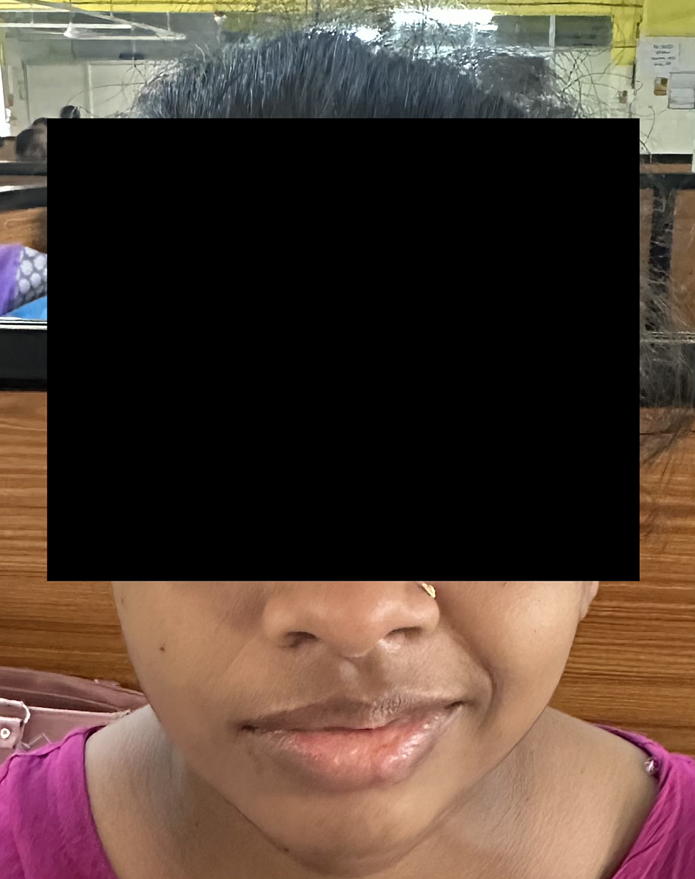 Cureus Bell’s Palsy Unmasked A Compelling Case Study of Facial Nerve