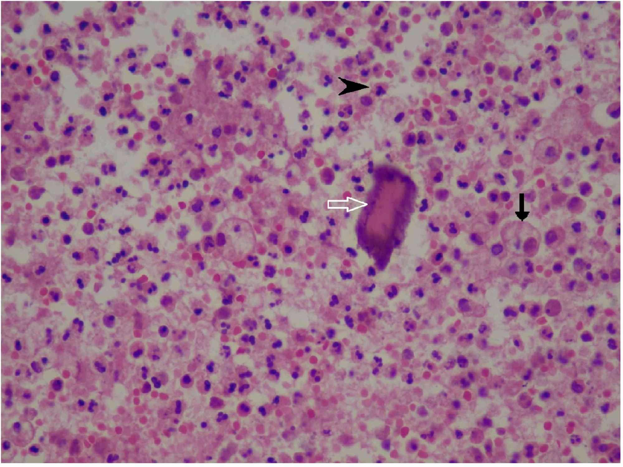 Cureus | A Rare Case Report on Xanthogranulomatous Osteomyelitis of Hip ...