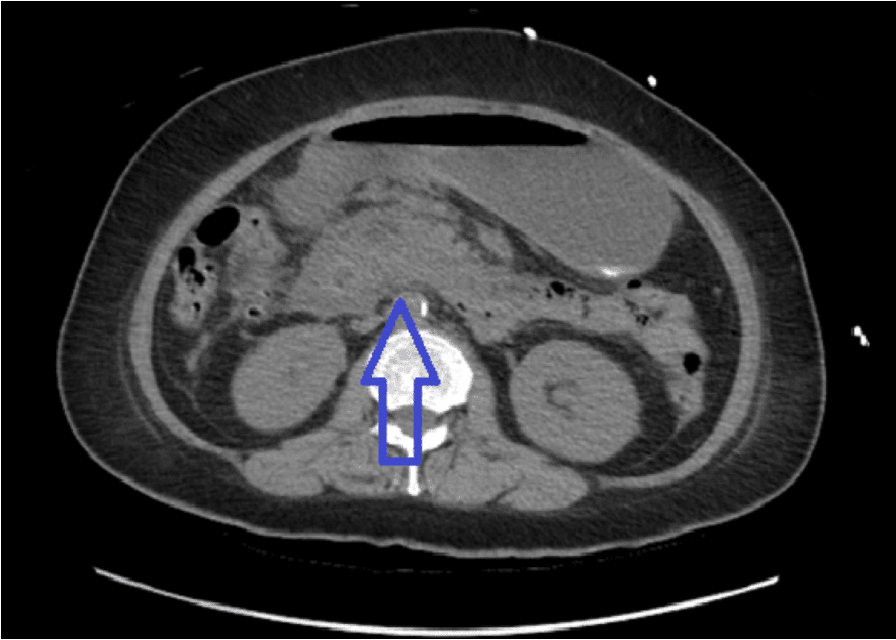 Cureus | A Rare Case of Sodium-Glucose Cotransporter-2 Inhibitor ...