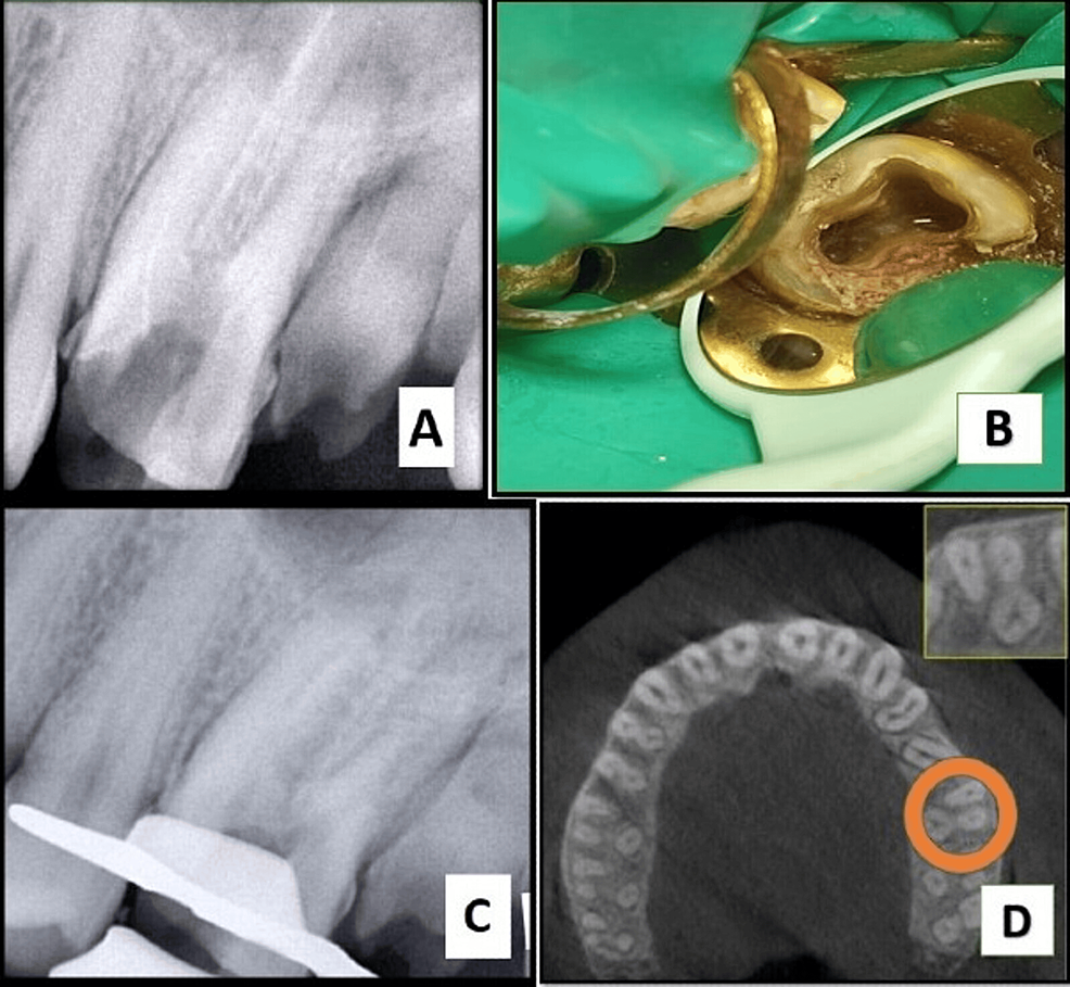 Endodontic Retreatment of a Maxillary First Molar With Orthograde