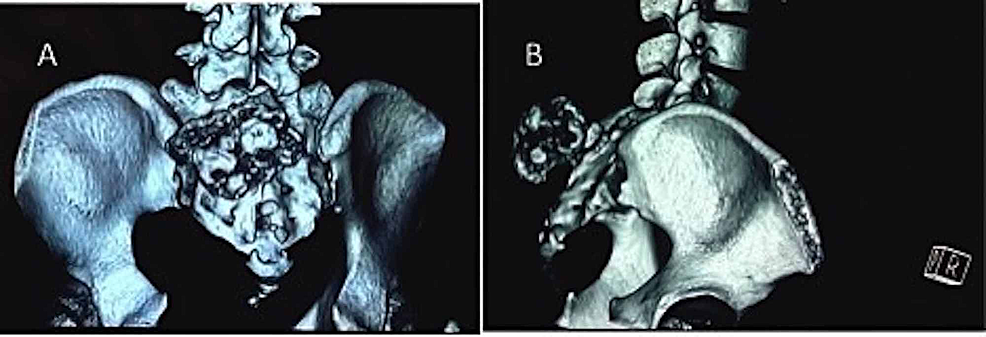 CT-scan-clearly-delineates-the-growth-on-the-left-side-of-the-sacrum-arising-from-the-S2-3-level
