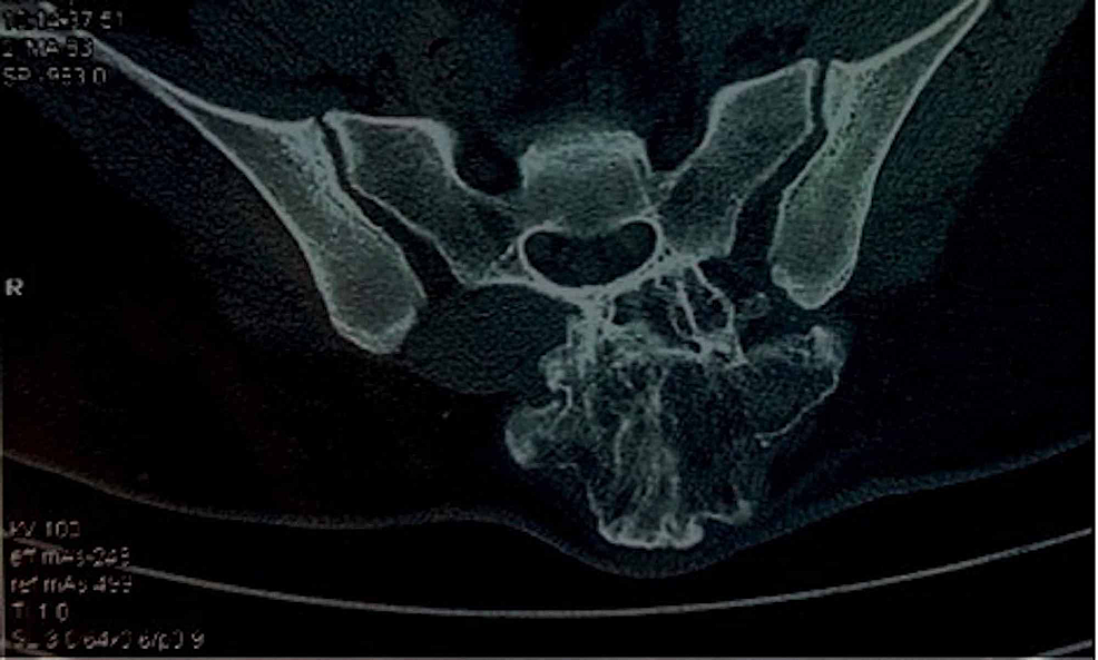 Transverse-cut-section-of-the-CT-scan-shows-a-cauliflower-like-bony-outgrowth-arising-from-the-posterior-aspect-of-the-sacrum-on-the-left-side