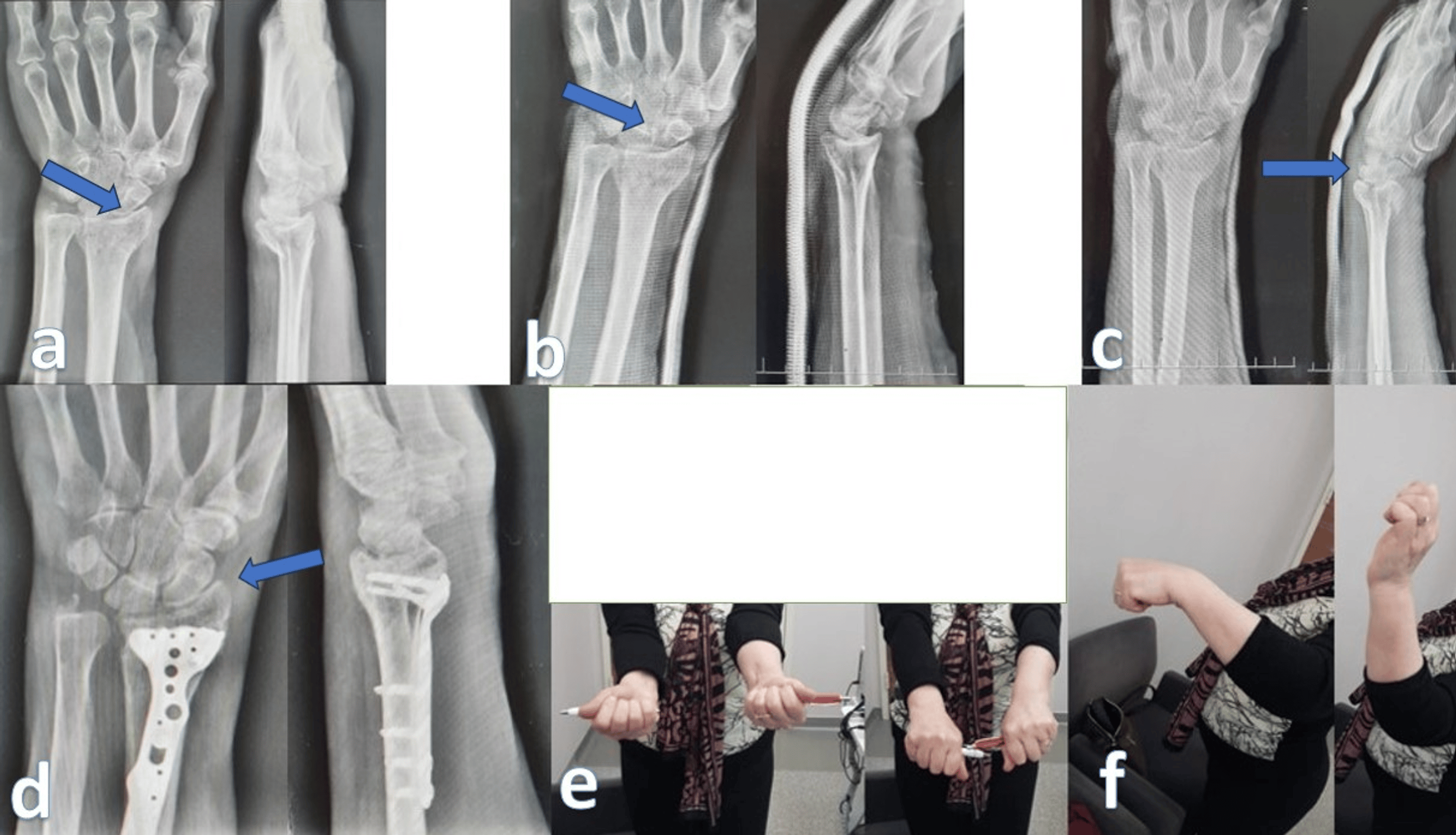 Open Reduction and Plate Fixation, External Fixator, and Conservative