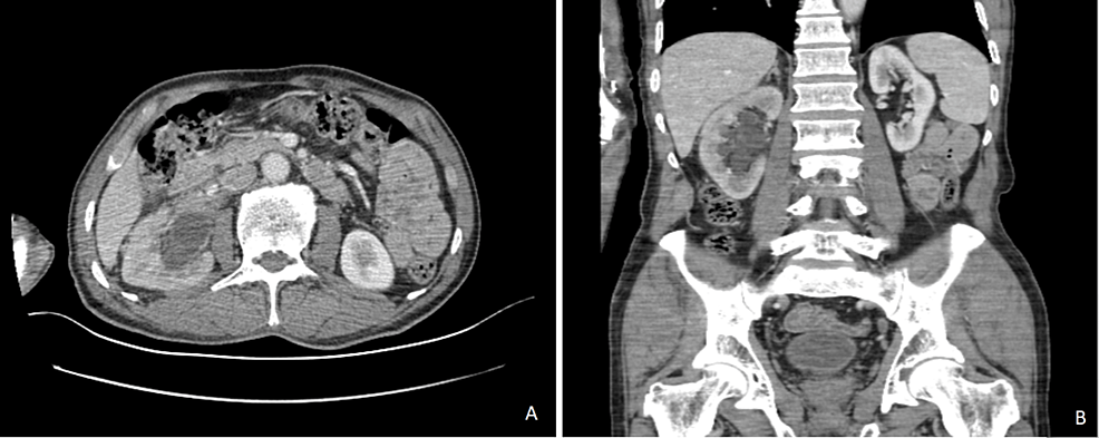 metastatic melanotic sarcoma PDF] Giant melanotic neuroectodermal tumor of infancy (melanotic progonoma)  of the head and neck: report of a malignant case main image 0