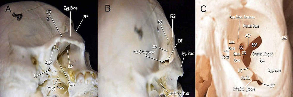 Cureus Immersive Surgical Anatomy Of The Craniometric 0770