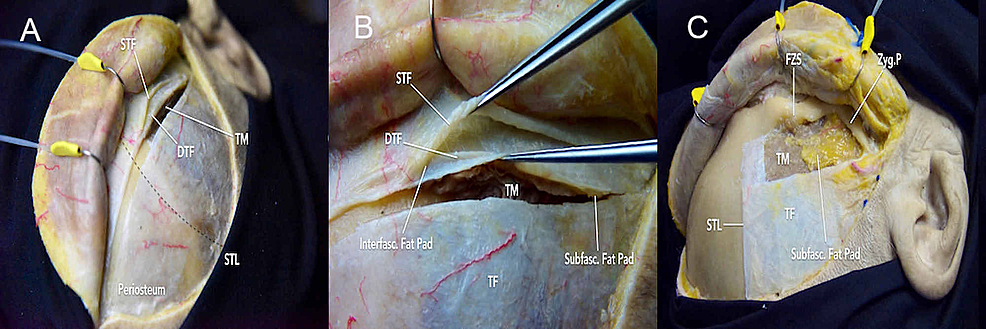 Cureus | Immersive Surgical Anatomy of the Frontotemporal