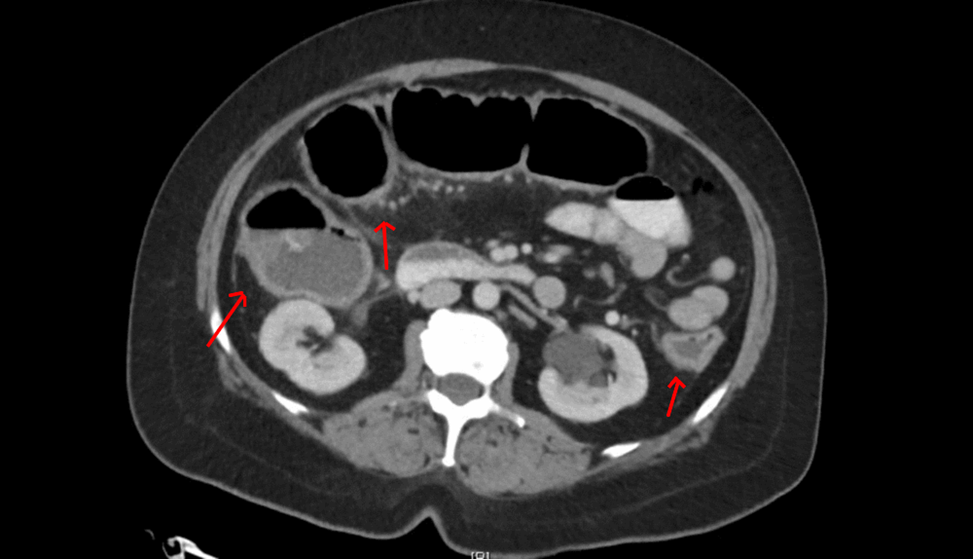 cureus-immune-mediated-colitis-from-dual-checkpoint-inhibitors