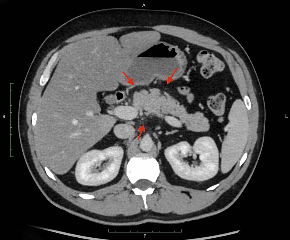 診断病理学：肝胆膵　２版 Hepatobiliary and Pancreas Hepatobiliary & Pancreatic Diseases International | Journal