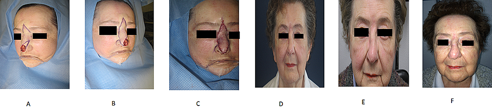 Cureus | The Axial Frontonasal Flap for Nasal Tip Defect: A Single ...