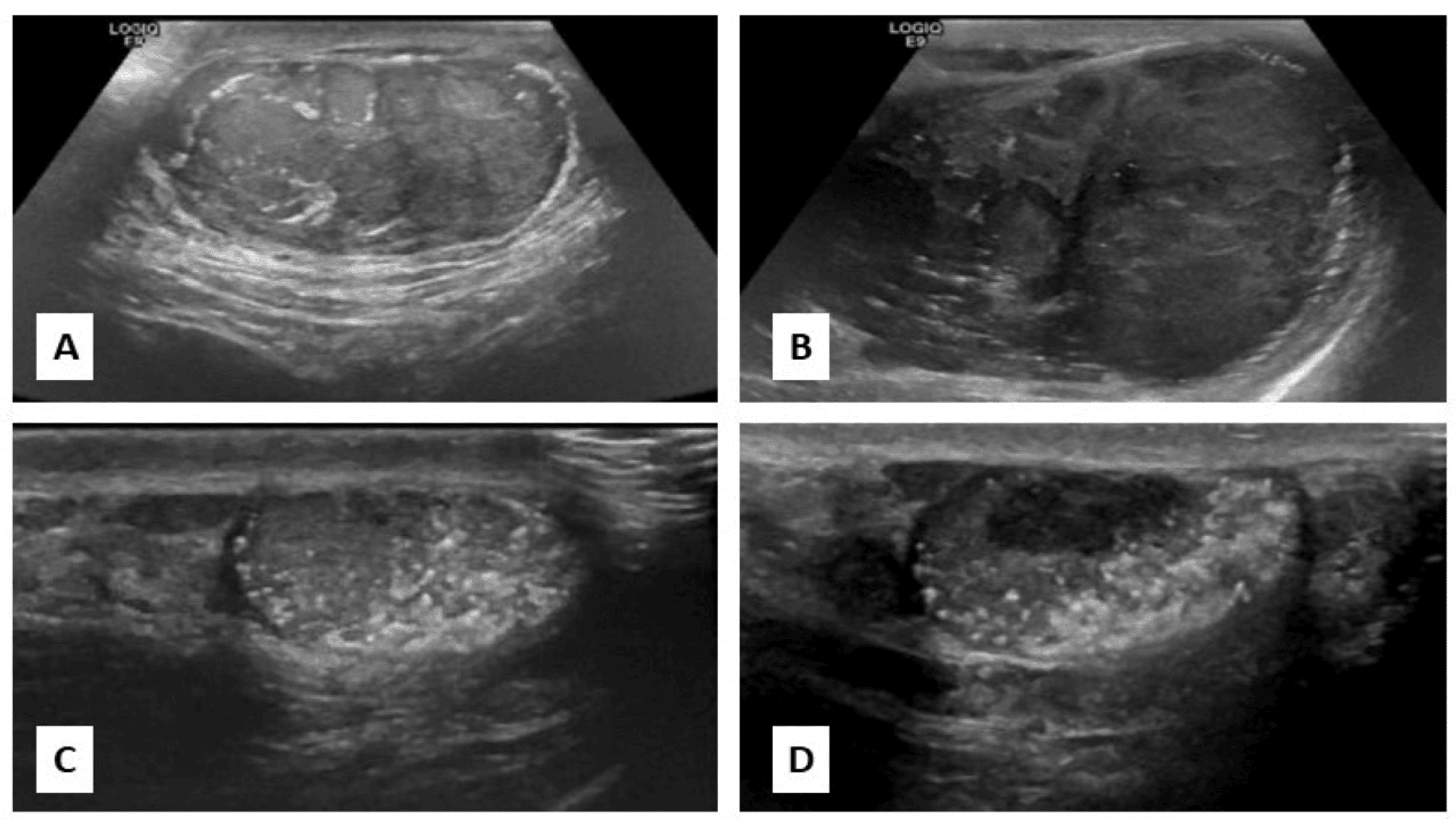 Cureus Synchronous Bilateral Testicular Tumors With Discordant Histopathology A Rare Case In 5010