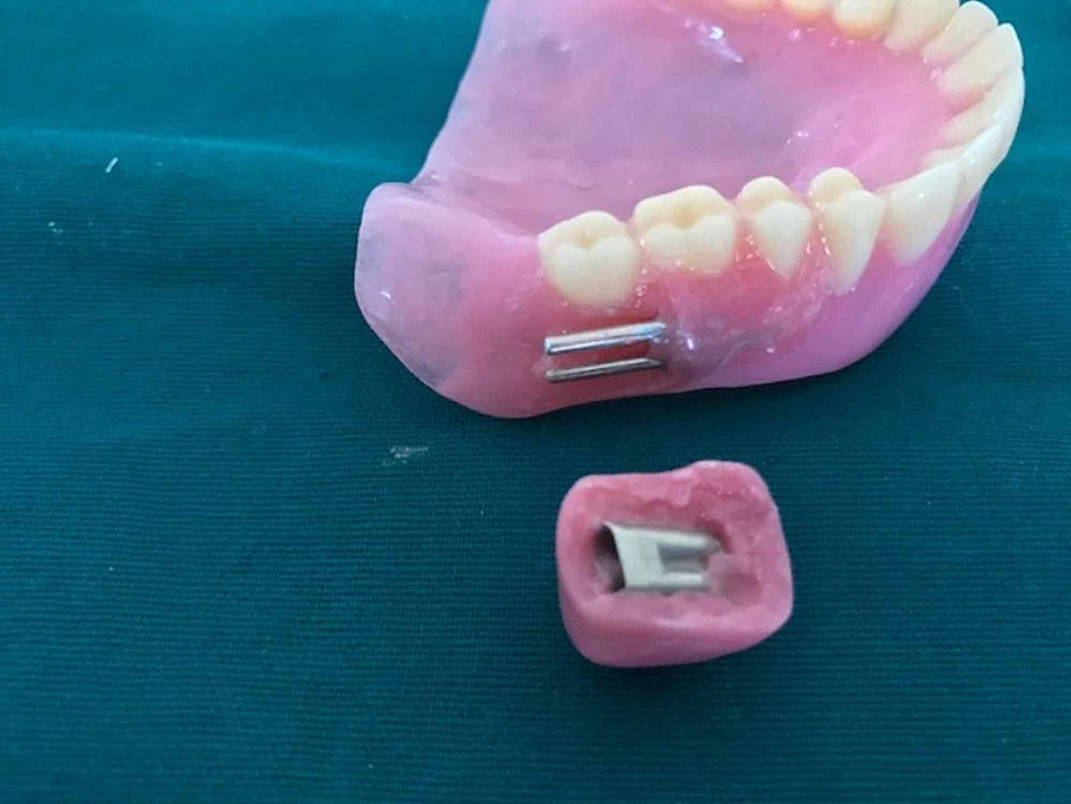 Cureus An Innovative Technique Using a Stainless Steel Double Die Pin