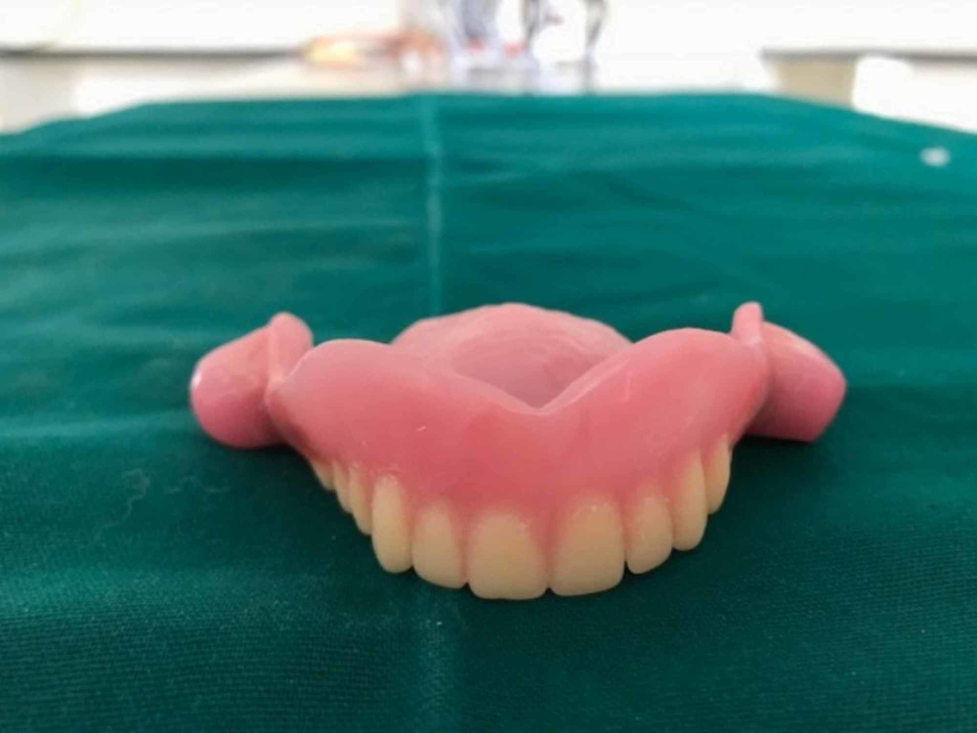 Cureus An Innovative Technique Using a Stainless Steel Double Die Pin