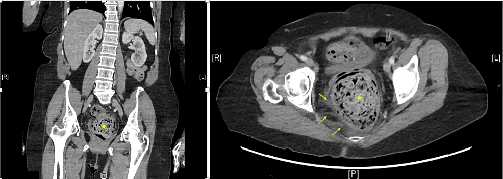 Fecal impaction, Radiology Reference Article