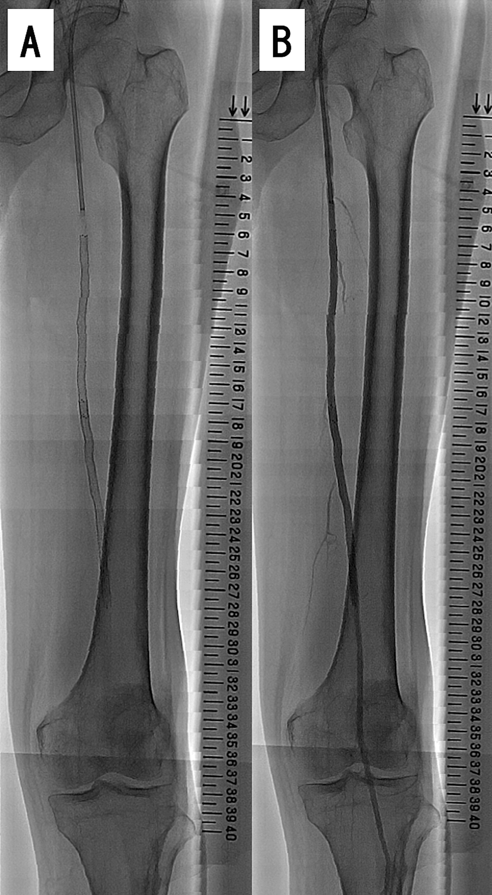 Successful Removal of an Entrapped Stent Delivery Catheter Using Two ...