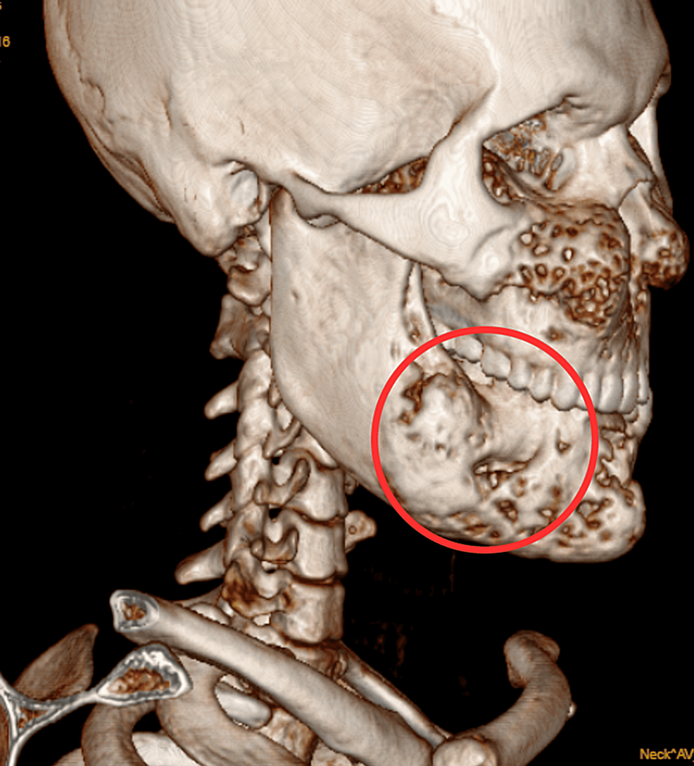 Wpływ protokołu rehabilitacji multimodalnej u 20-letniego pacjenta z anafilaksją, który przeszedł operację twarzy: rzadki opis przypadku