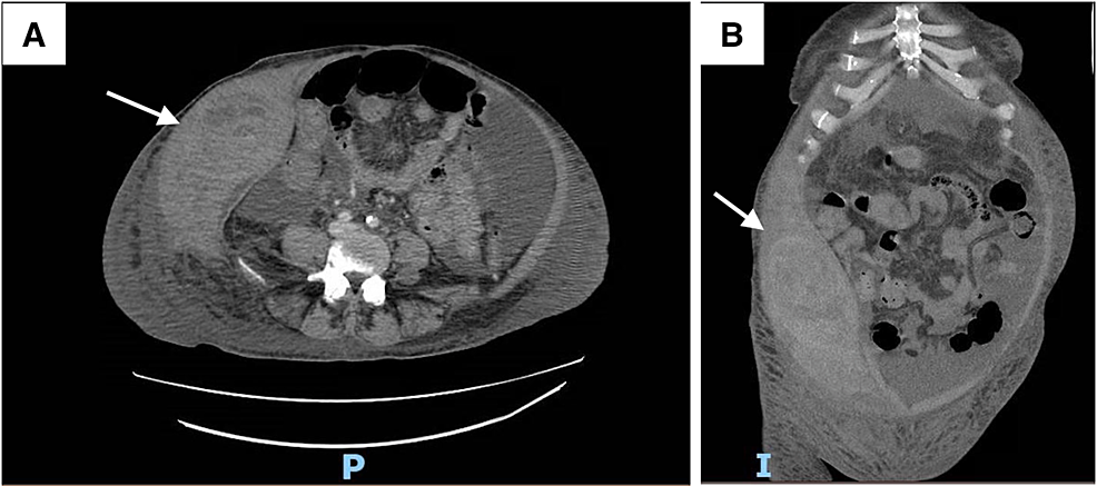 Abdominal Hematoma Ultrasound