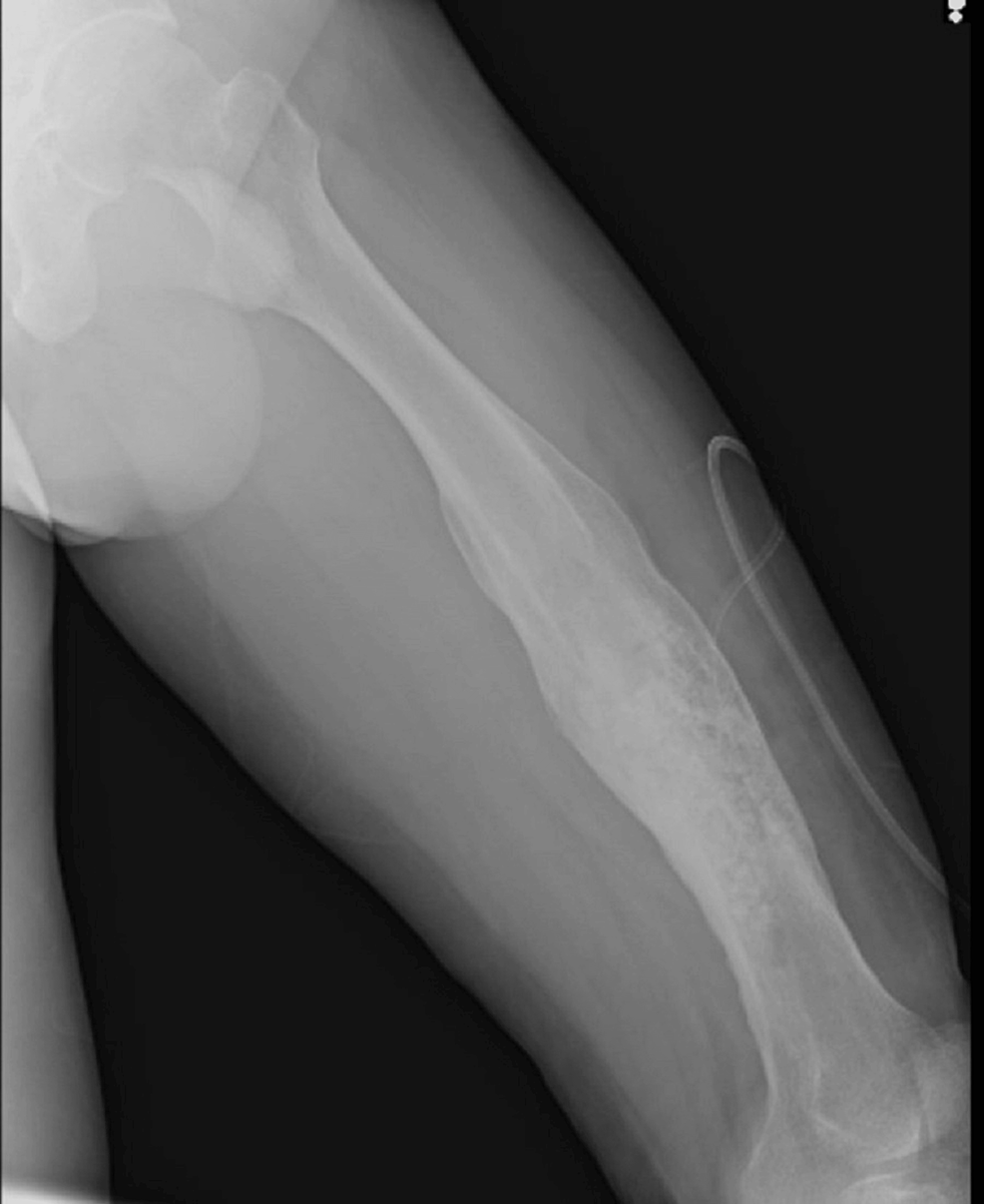 Cureus Squamous Cell Carcinoma Arising in Chronic Osteomyelitis A