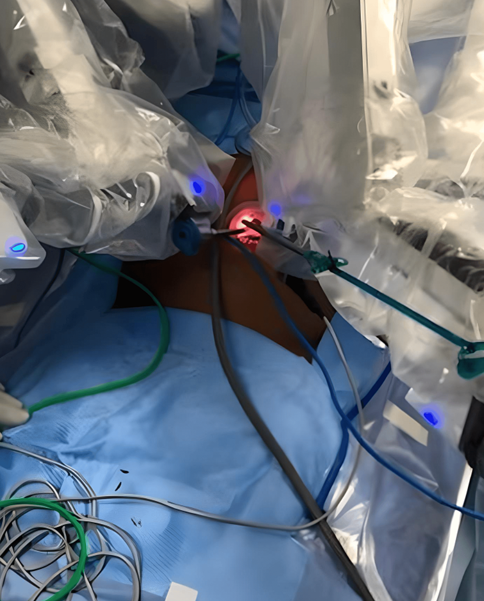 Cureus Robotic SingleSite Cholecystectomy A SingleCenter Retrospective Study