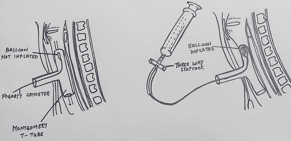 Montgomery-T-tube-and-Fogarty-catheter-arrangement