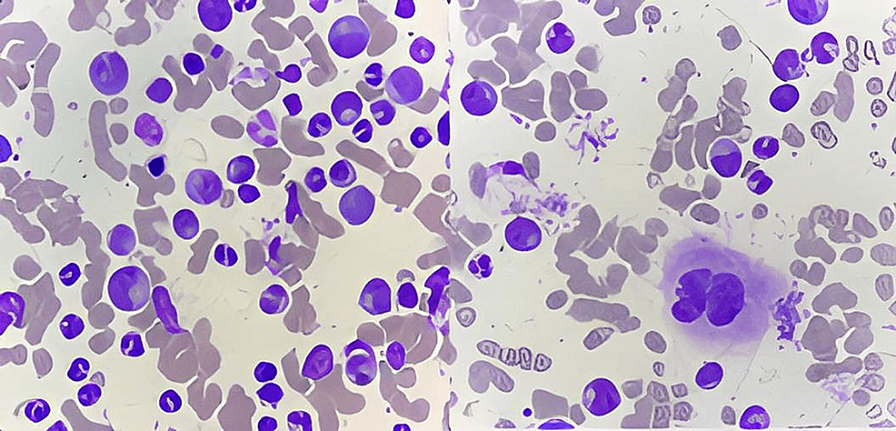 Cureus | bi-lineage b- and t-lymphoid extramedullary blast crisis at an