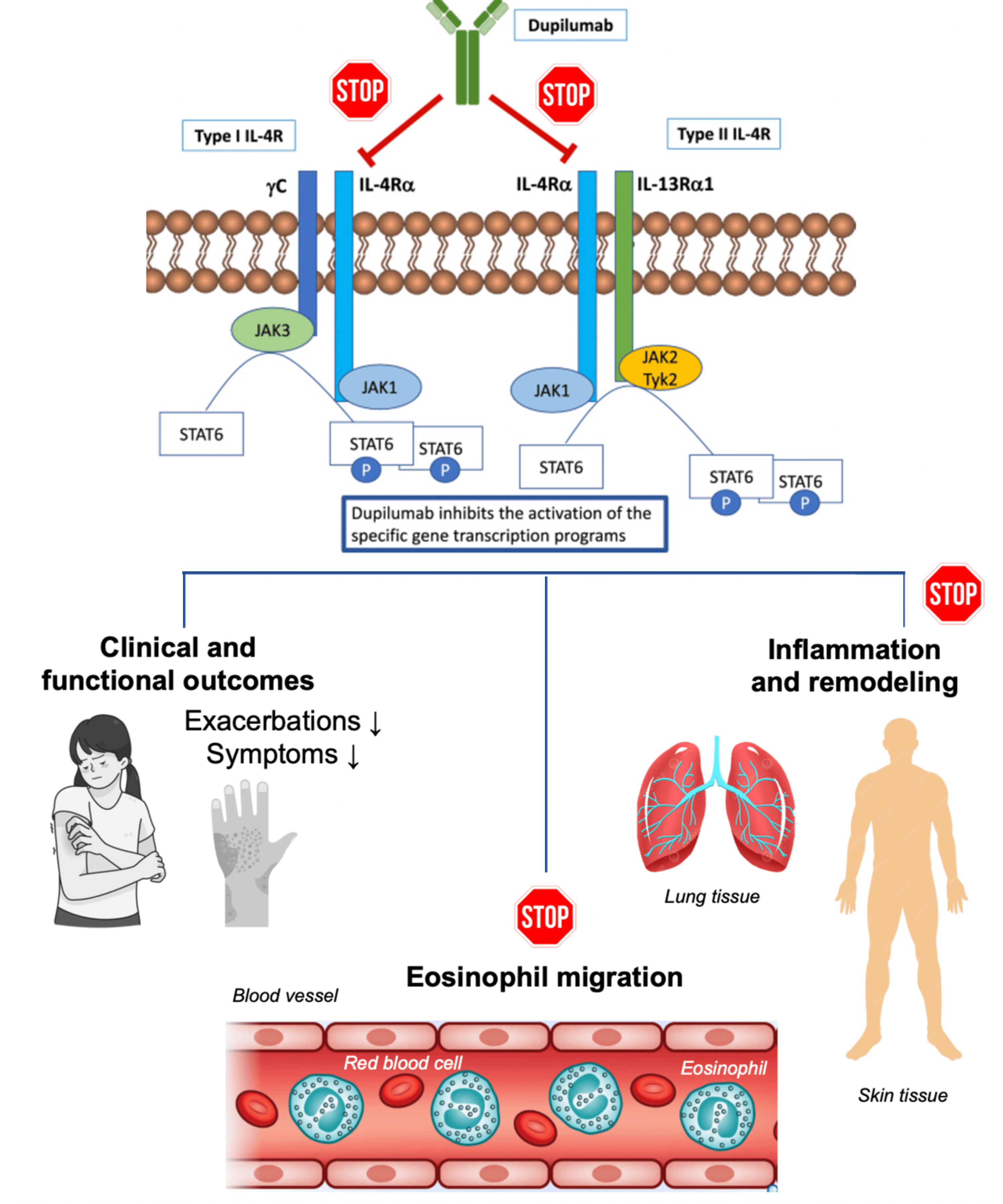 Revolutionizing Dupilumab Treatment In Refractory Eosinophilic ...