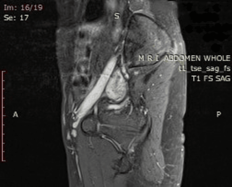 Cureus Postabortal Bleeding A Diagnostic Dilemma Resolved As