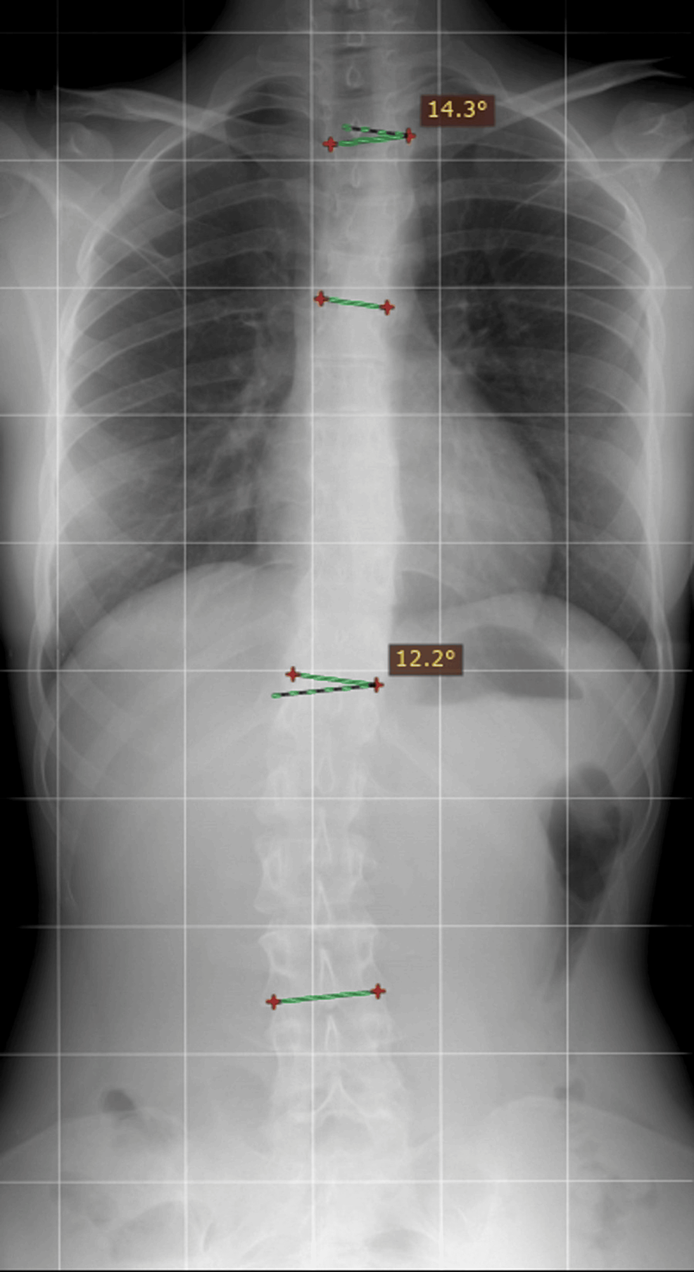 Cureus | cough-induced multiple, bilateral, asymmetrical rib fractures