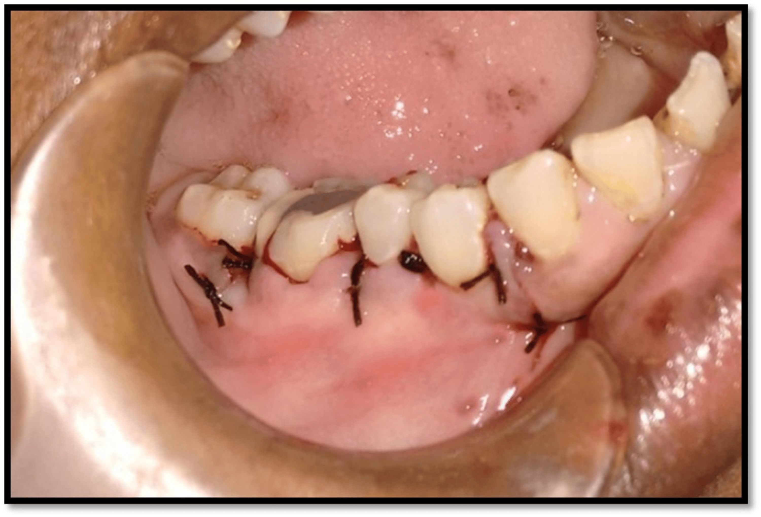 Successful Management of a Tooth With an EndodonticPeriodontal Lesion