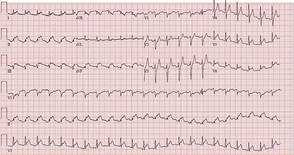 Cureus | Acute Decompensated Heart Failure Secondary to Exogenous ...