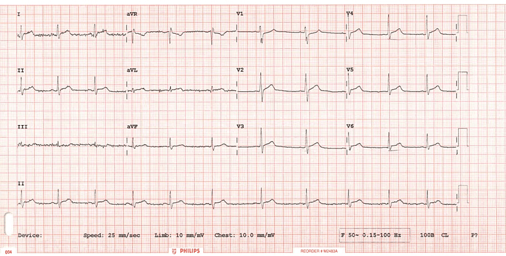 A Young Male Presenting With Chest Pain, Elevated Troponin Levels, And 