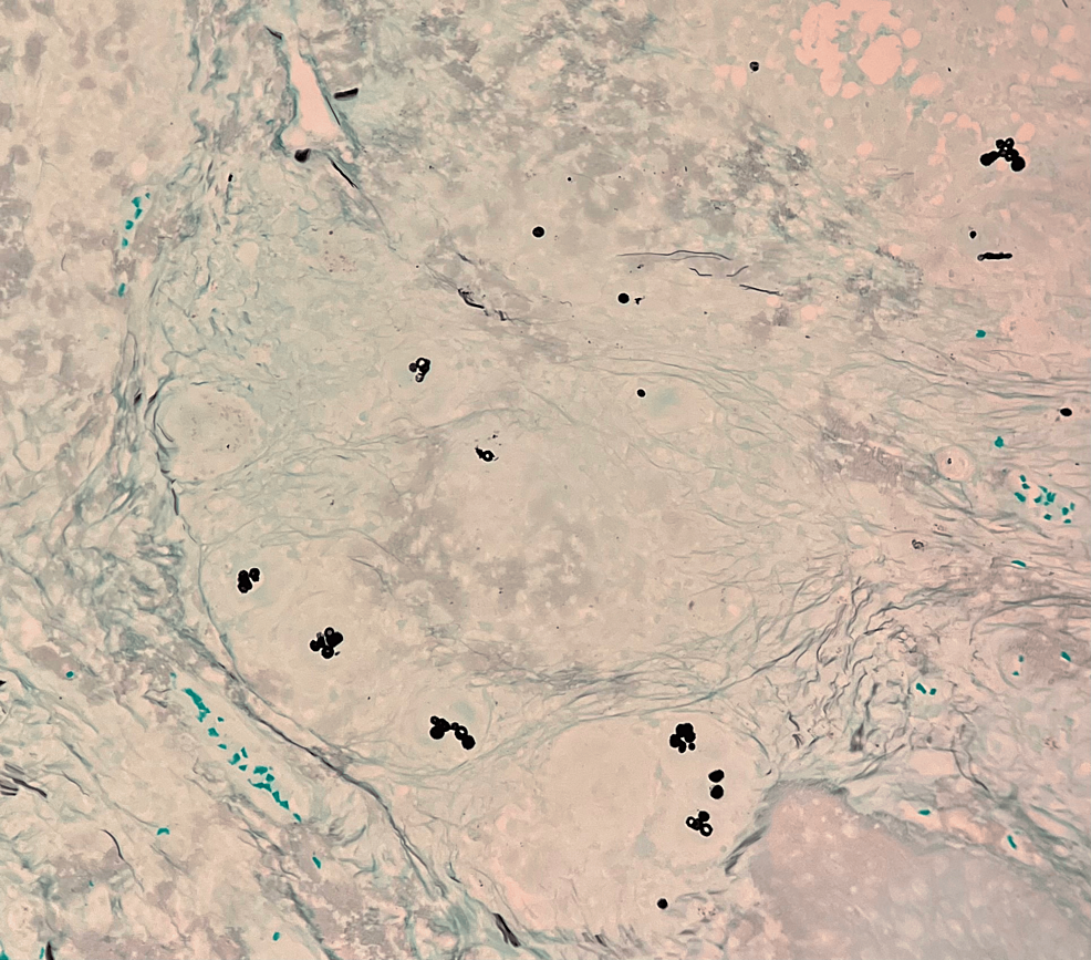 Cureus | Chromoblastomycosis Presenting as a Solitary Lesion in a Non ...