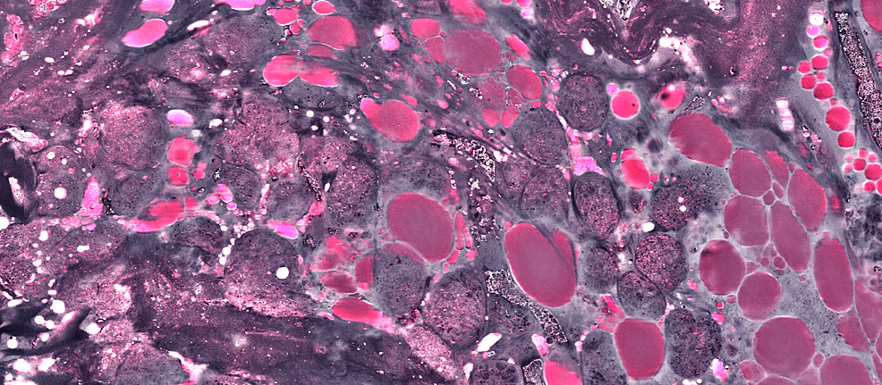 Lacrimal-gland-showing-organized-glandular-tissue-and-lipid-deposits;-no-tumor-seen