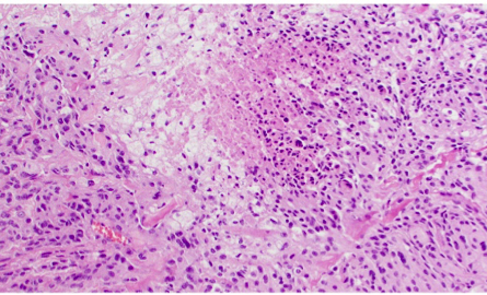 H&E-staining-of-WHO-grade-II-meningioma-at-high-power-magnification;-necrosis-is-seen-in-the-center-of-the-image