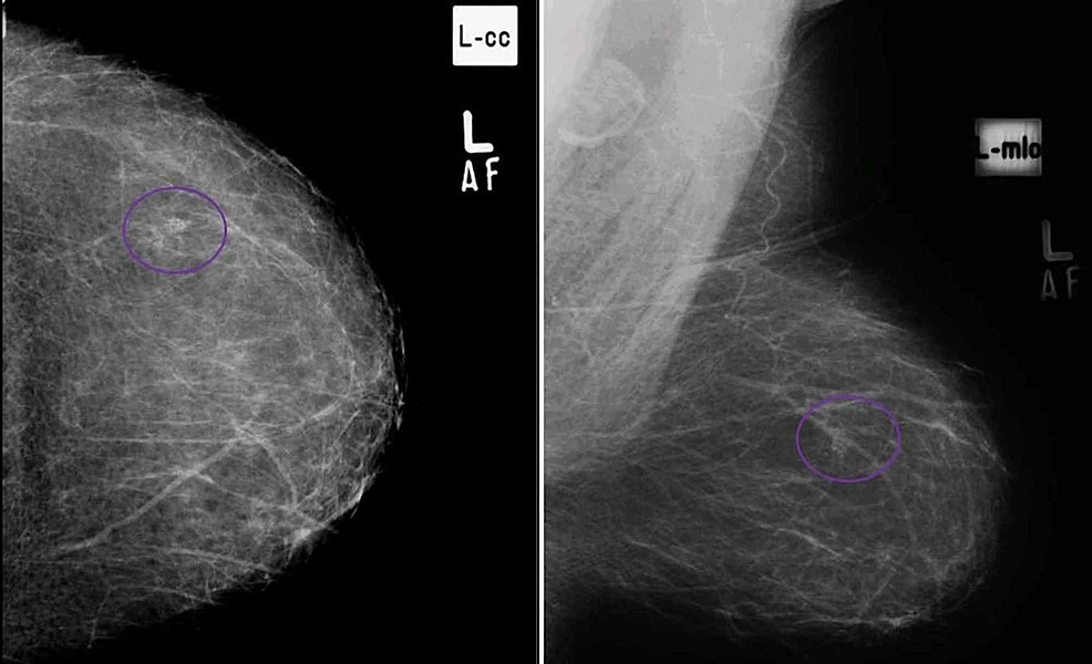 Microcalcifications in Breast Cancer