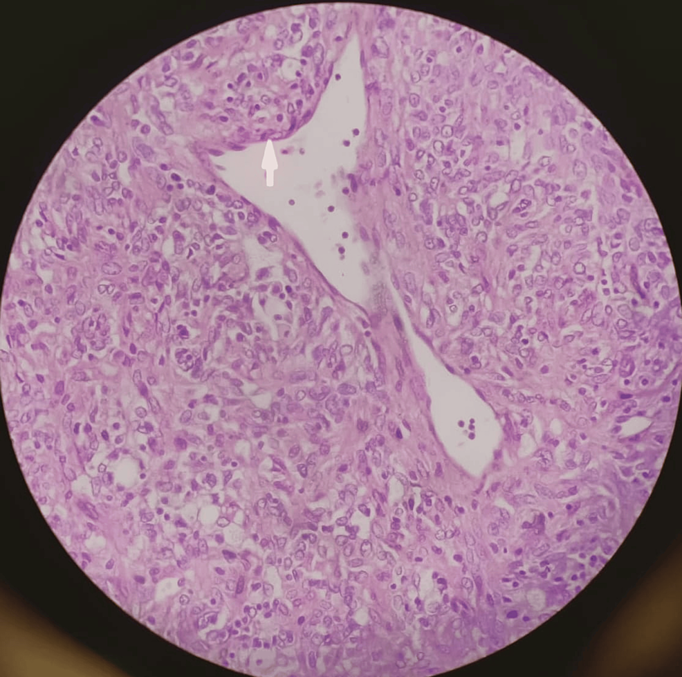 Cureus Adult Para Testicular Spindle Cell A Case