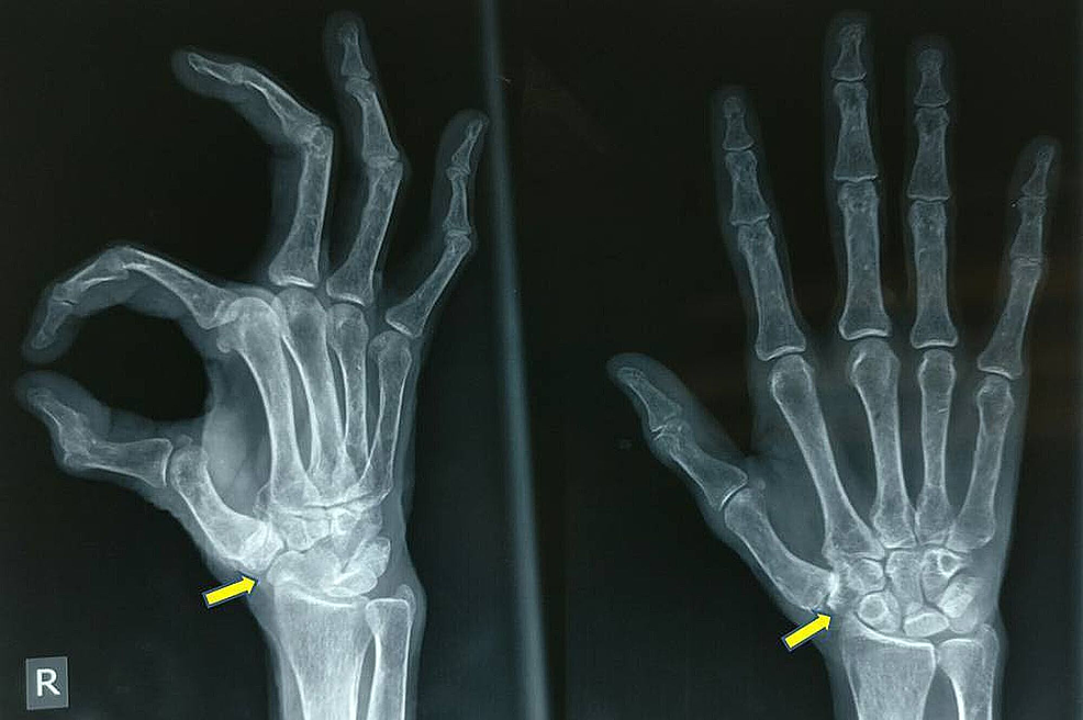 thumb-arthritis-graham-plastic-surgery-plastic-surgery-rochester-ny