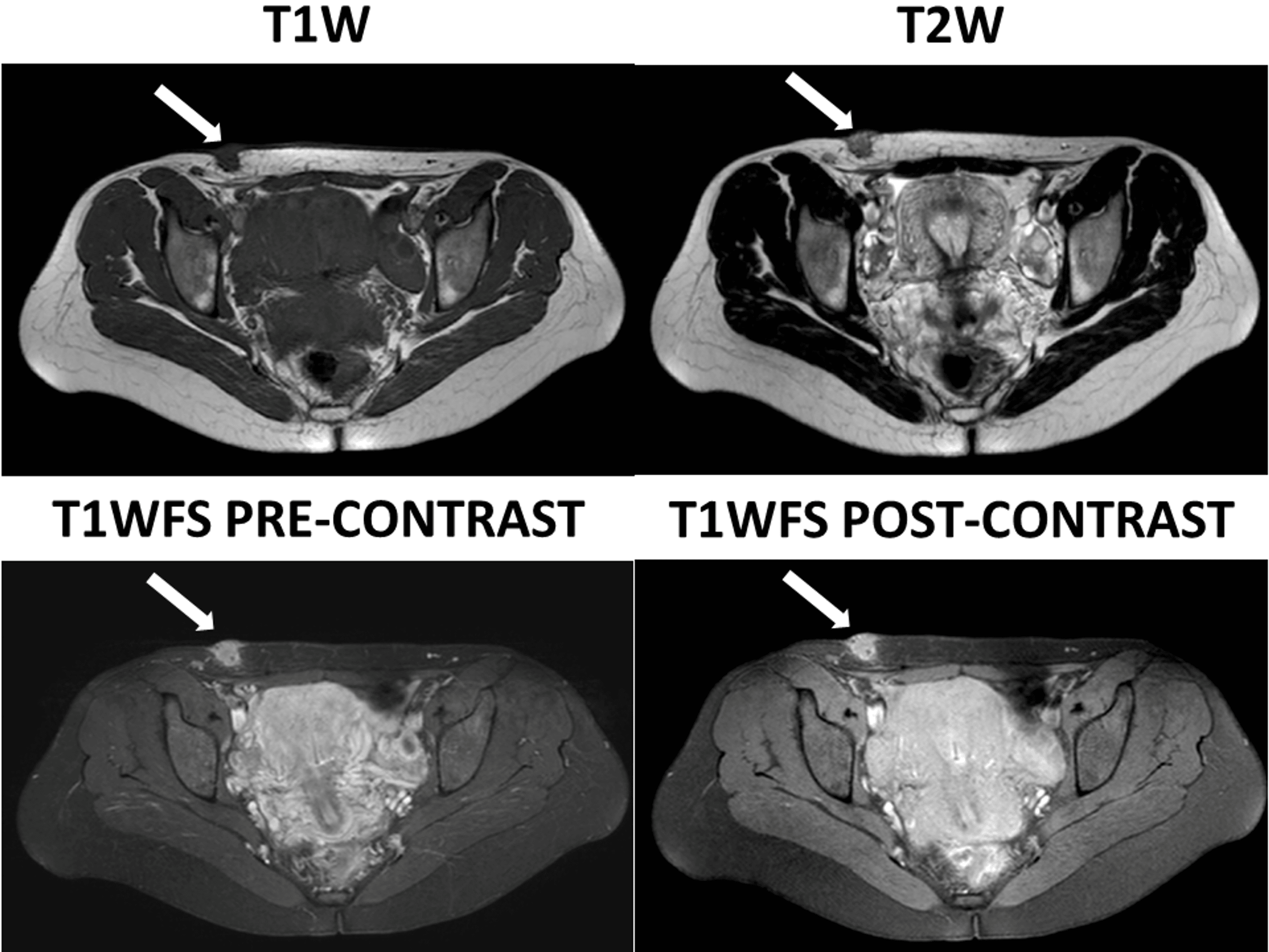 A Typical Presentation Of Cesarean Section Scar Endometriosis A Case Report Cureus 7824