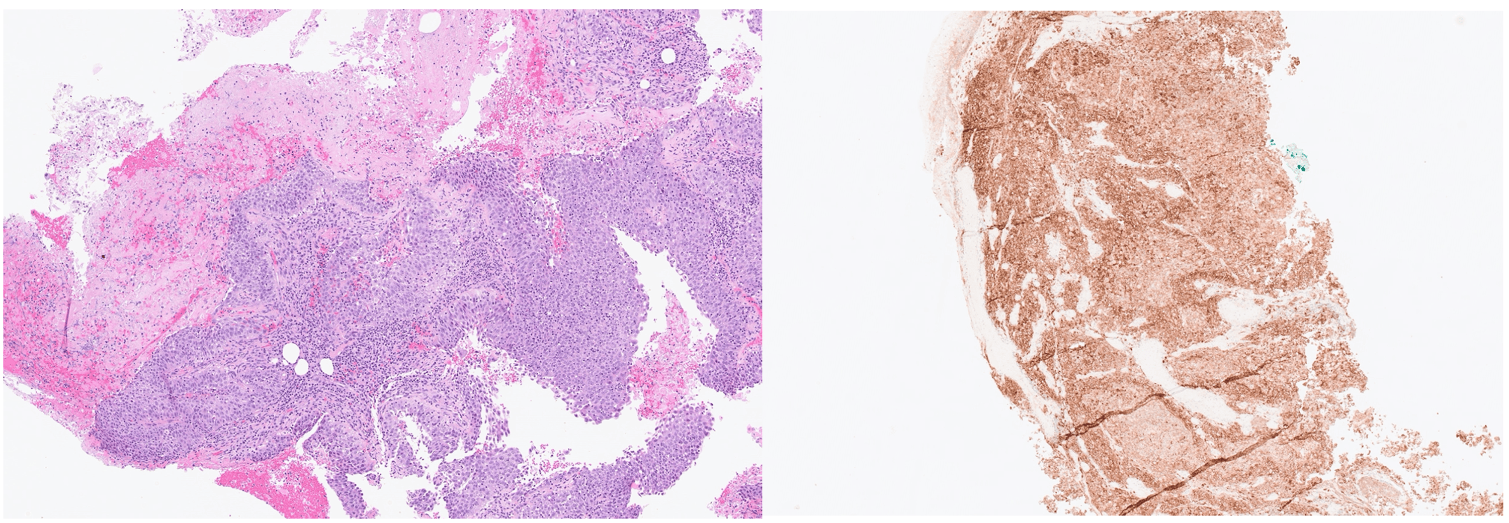 Cureus | a rapidly enlarging skin lump